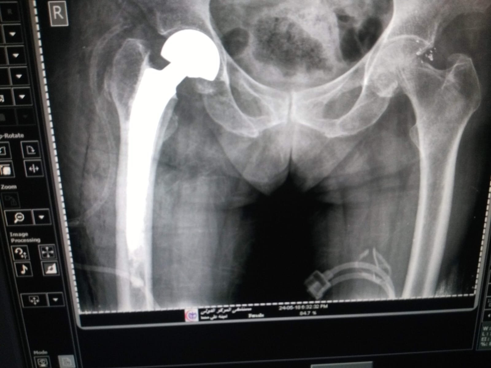 علاج خشونة المفاصل